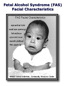 Fetal Alcohol Syndrome