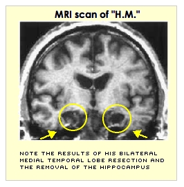 H.M. hippocampus