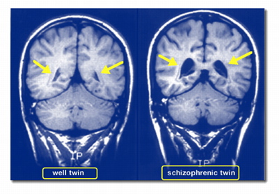 [SZ
                Ventricles]