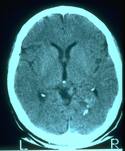 [Cat
                  Scan Tumor]