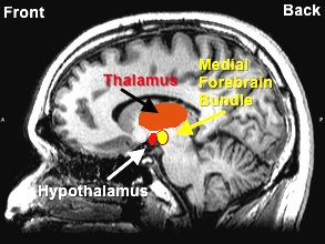 medial forebrain bundle