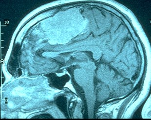 [MRI
                  Image Tumor]