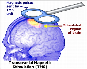 [Transcranial Magnetic Stimulation]