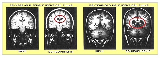 [Schizophrenia Brain]