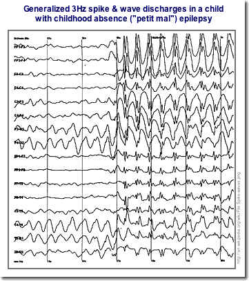 EEG Child
            with Petit Mal Epilepsy