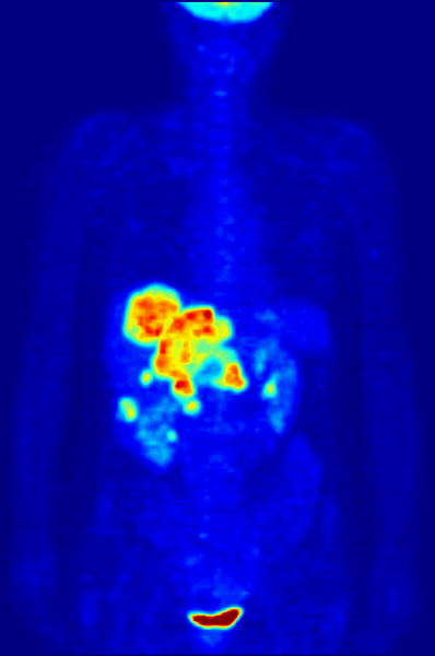 Animated PET scan
            of whole body