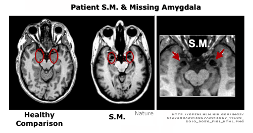 SM Amygdala