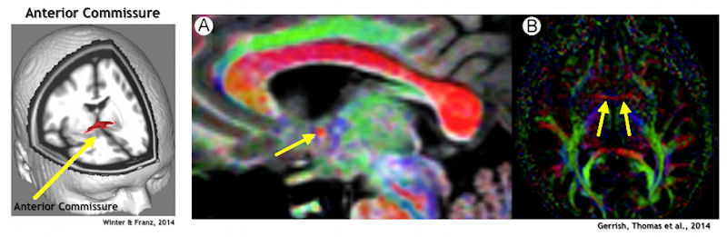 Anterior Commissure
