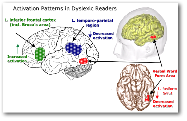 dyslexic
              reading brain