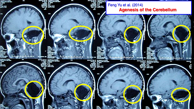 Feng Yu Missing Cerebellum