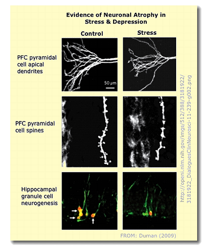 Neuronal atrophy