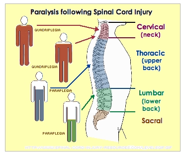 Paralysis following spinal cord injury
