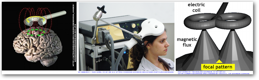 Transcranial magnetic
          stimulation
