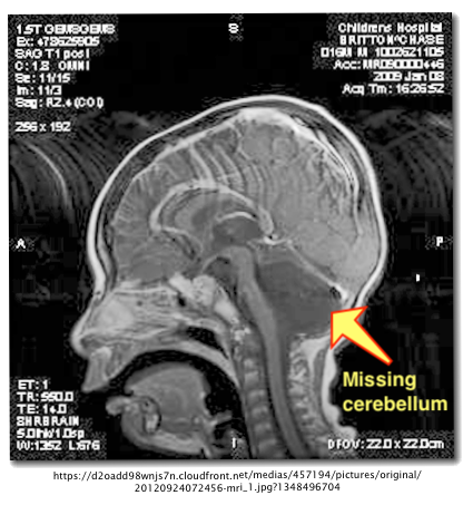 Chase Britton Missing Cerebellum