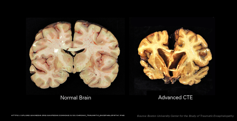 Normal Brain vs. Advanced CTE