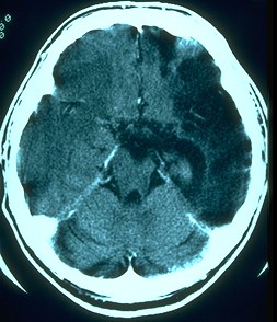 CAT Scan -
            hemorrhage