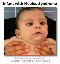 Mobius syndrome
