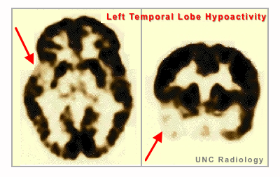 PET Temporal Lobe Hypoactivity