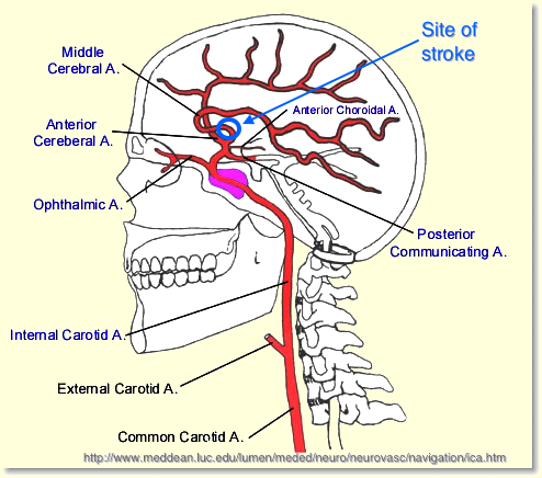 ICA
                Stroke