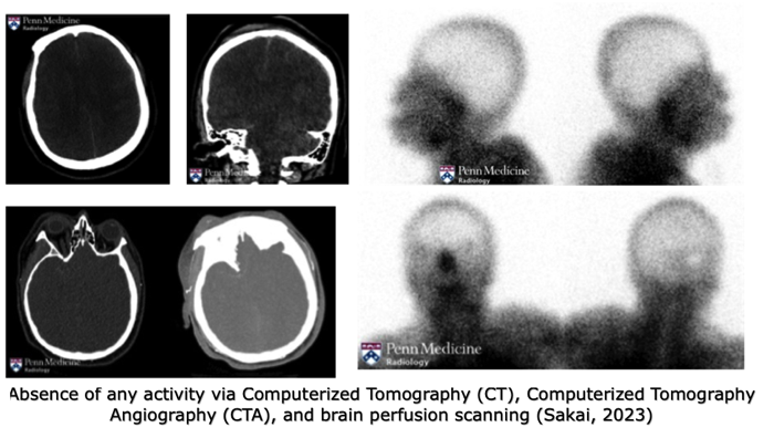 Brain death scanning