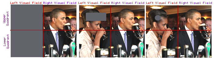 [Visual Field Defects Examples
                  Obama]