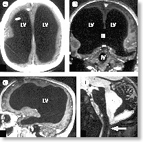 [MRI image of hydrocephalus]